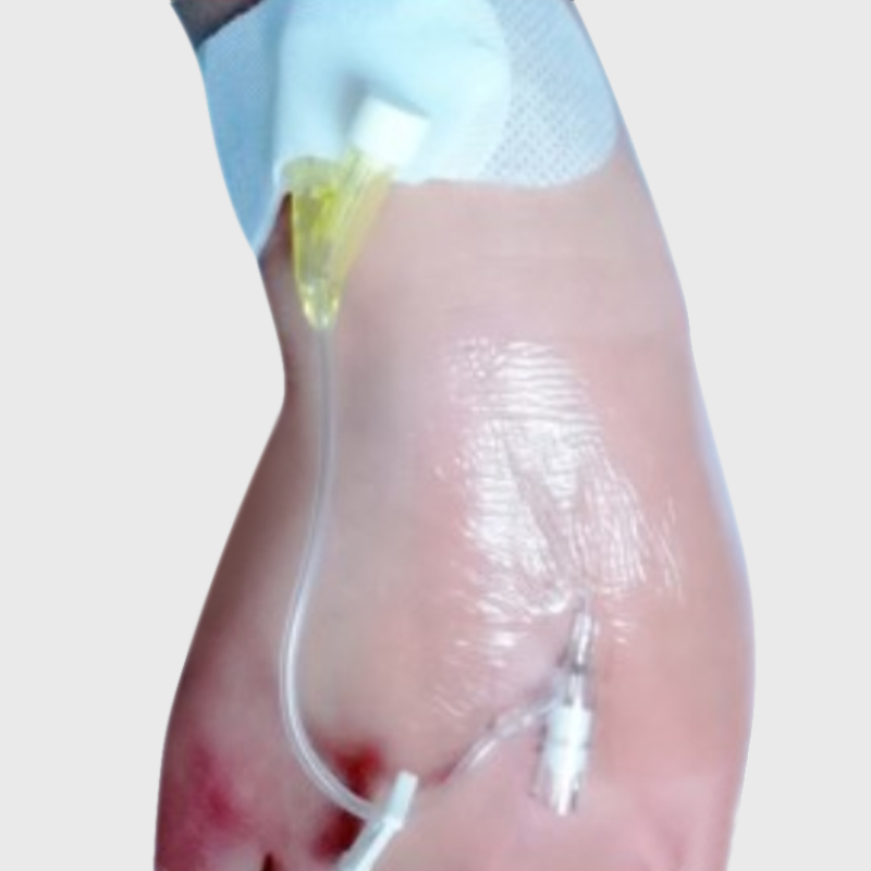 Catheter Securement Dressing